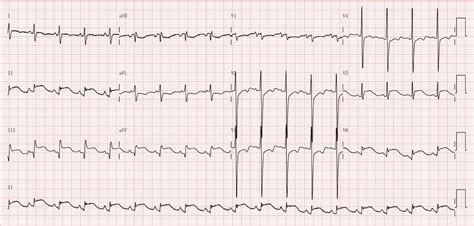 abnormal ekg results|Iba pa.